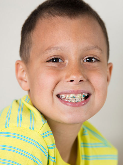 early orthodontic treatment